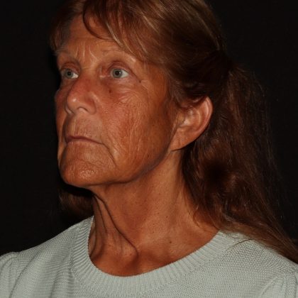 Deep Plane Facelift & Necklift Before & After Patient #1405