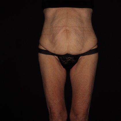 Weight Loss Before & After Patient #1402