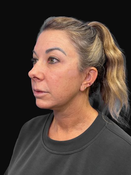 Deep Plane Facelift & Necklift Before & After Patient #1495