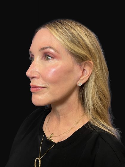 Deep Plane Facelift & Necklift Before & After Patient #1496