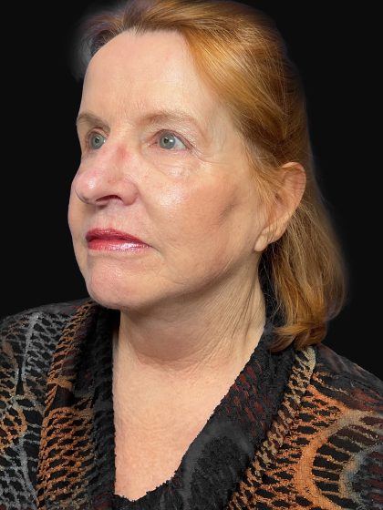 Deep Plane Facelift & Necklift Before & After Patient #1497