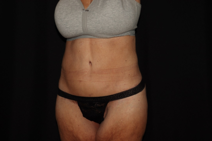 Weight Loss Before & After Patient #1345