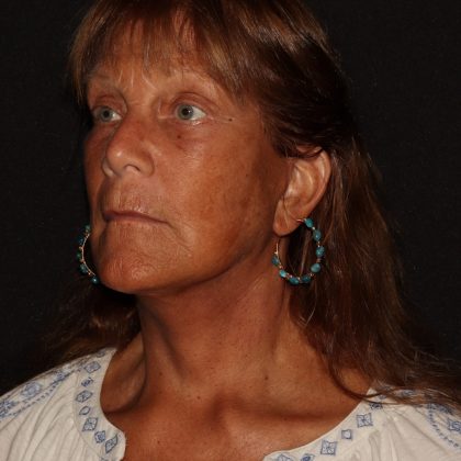 Deep Plane Facelift & Necklift Before & After Patient #1405