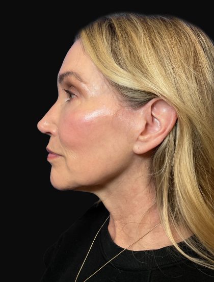 Deep Plane Facelift & Necklift Before & After Patient #1496