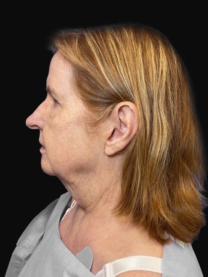 Deep Plane Facelift & Necklift Before & After Patient #1497