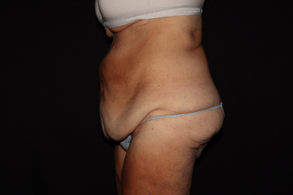 Weight Loss Before & After Patient #1345