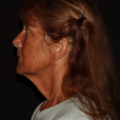 Deep Plane Facelift & Necklift Before & After Patient #1405