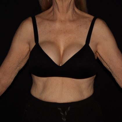 Weight Loss Before & After Patient #1402