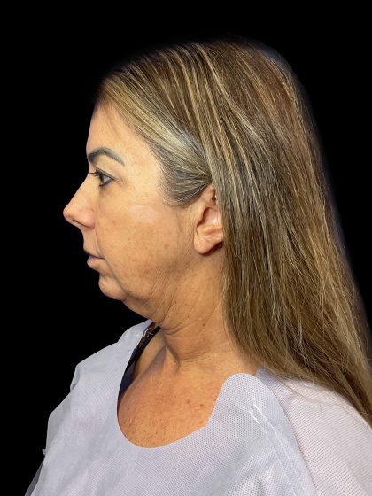 Deep Plane Facelift & Necklift Before & After Patient #1495