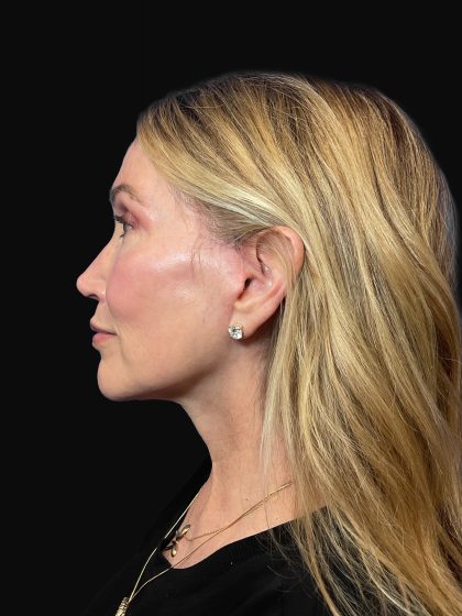 Deep Plane Facelift & Necklift Before & After Patient #1496