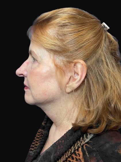 Deep Plane Facelift & Necklift Before & After Patient #1497