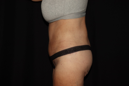 Weight Loss Before & After Patient #1345