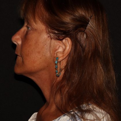 Deep Plane Facelift & Necklift Before & After Patient #1405