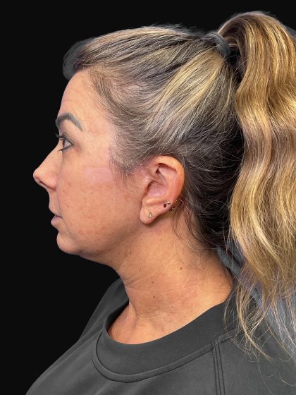 Deep Plane Facelift & Necklift Before & After Patient #1495
