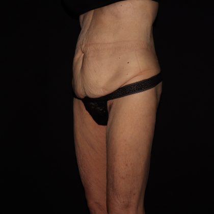 Weight Loss Before & After Patient #1402