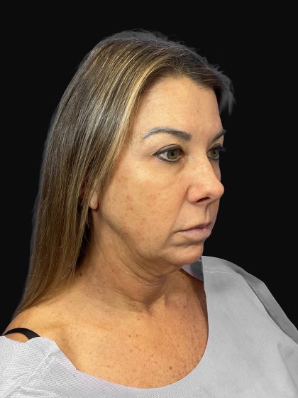 Deep Plane Facelift & Necklift Before & After Patient #1495