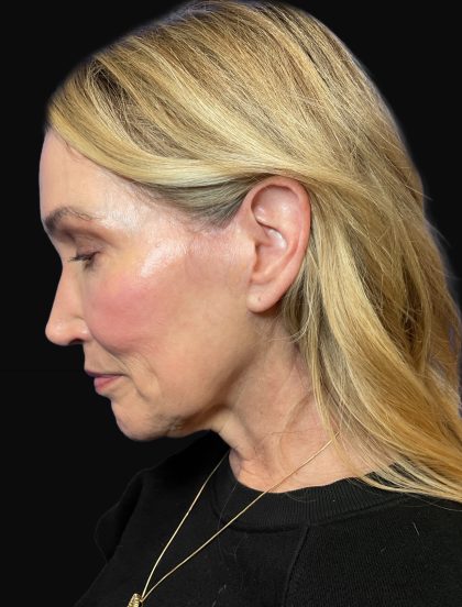 Deep Plane Facelift & Necklift Before & After Patient #1496