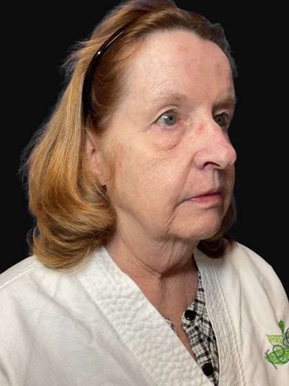 Deep Plane Facelift & Necklift Before & After Patient #1497