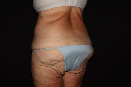 Weight Loss Before & After Patient #1345