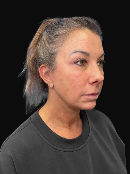 Deep Plane Facelift & Necklift Before & After Patient #1495