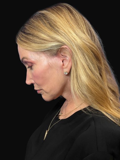 Deep Plane Facelift & Necklift Before & After Patient #1496