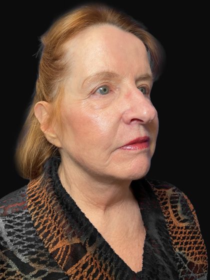 Deep Plane Facelift & Necklift Before & After Patient #1497