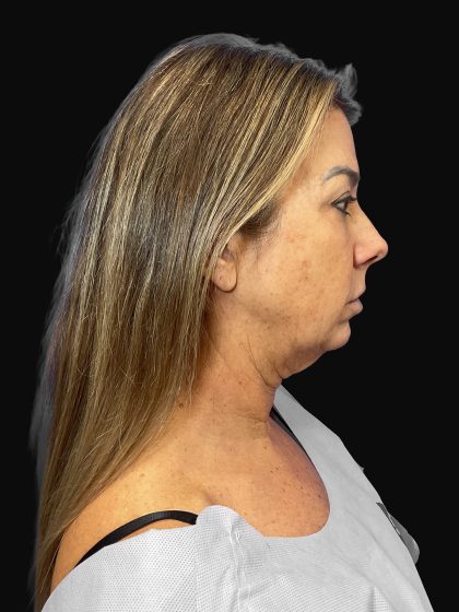 Deep Plane Facelift & Necklift Before & After Patient #1495