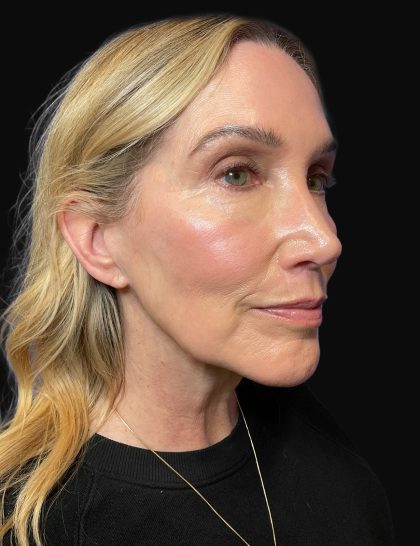 Deep Plane Facelift & Necklift Before & After Patient #1496