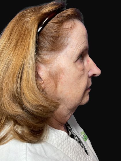 Deep Plane Facelift & Necklift Before & After Patient #1497