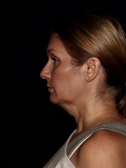 Deep Plane Facelift & Necklift Before & After Patient #1406