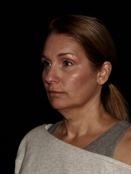 Deep Plane Facelift & Necklift Before & After Patient #1406