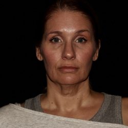 Deep Plane Facelift & Necklift Before & After Patient #1406