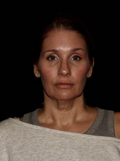 Deep Plane Facelift & Necklift Before & After Patient #1406