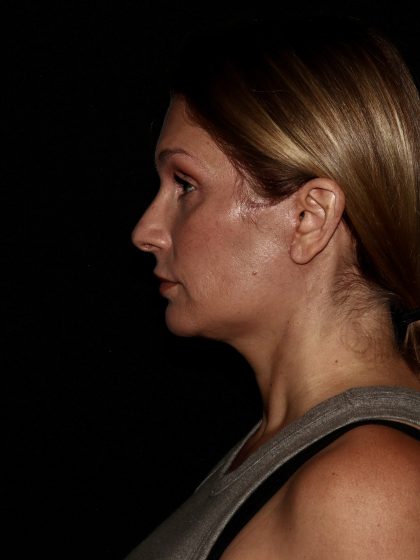 Deep Plane Facelift & Necklift Before & After Patient #1406