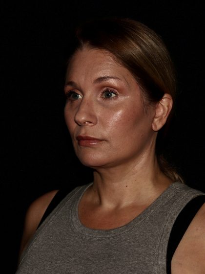 Deep Plane Facelift & Necklift Before & After Patient #1406