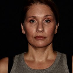 Deep Plane Facelift & Necklift Before & After Patient #1406
