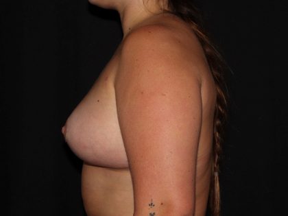 Breast Lift Before & After Patient #1303