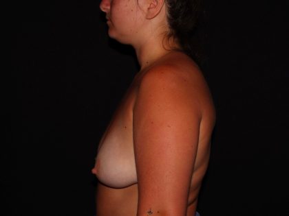 Breast Lift Before & After Patient #1303