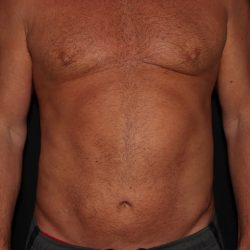 Gynecomastia Before & After Patient #1331