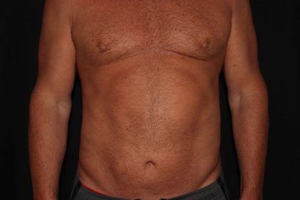 Gynecomastia Before & After Patient #1331