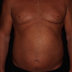 Gynecomastia Before & After Patient #1331