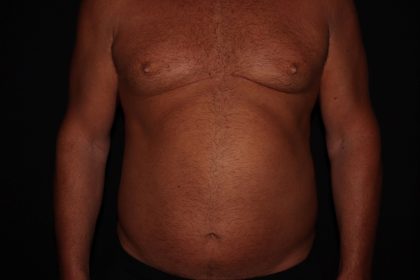 Gynecomastia Before & After Patient #1331