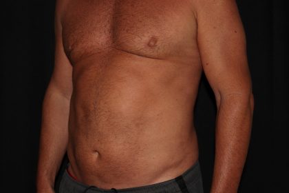 Gynecomastia Before & After Patient #1331