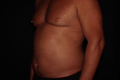 Gynecomastia Before & After Patient #1331