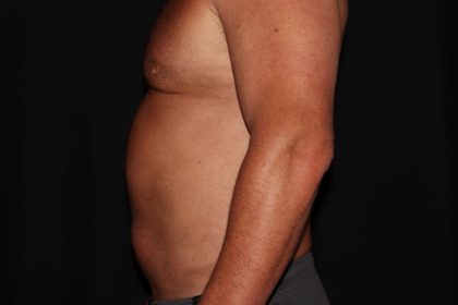 Gynecomastia Before & After Patient #1331