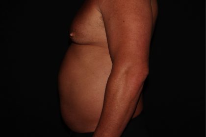 Gynecomastia Before & After Patient #1331