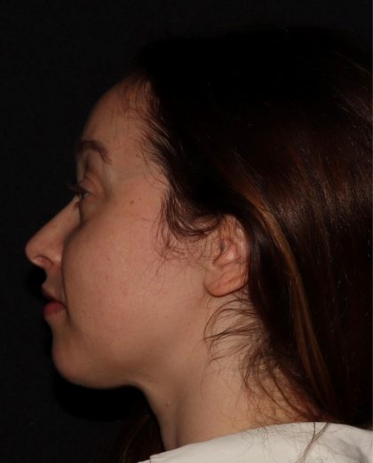 Eyelid Surgery Before & After Patient #1354