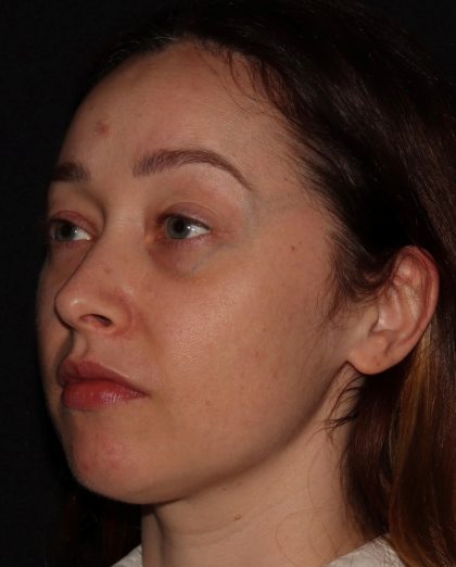 Eyelid Surgery Before & After Patient #1354
