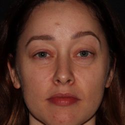 Eyelid Surgery Before & After Patient #1354
