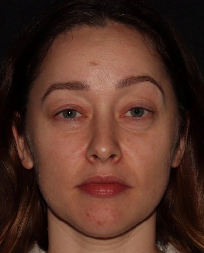 Eyelid Surgery Before & After Patient #1354